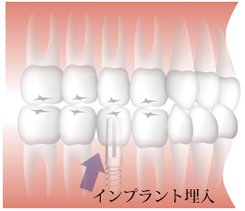 一本欠損