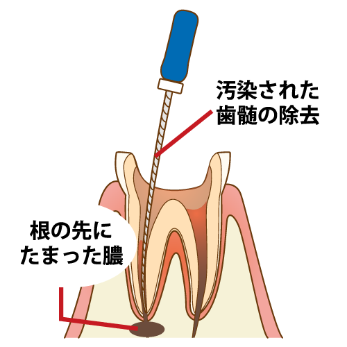 虫歯を放置するリスク