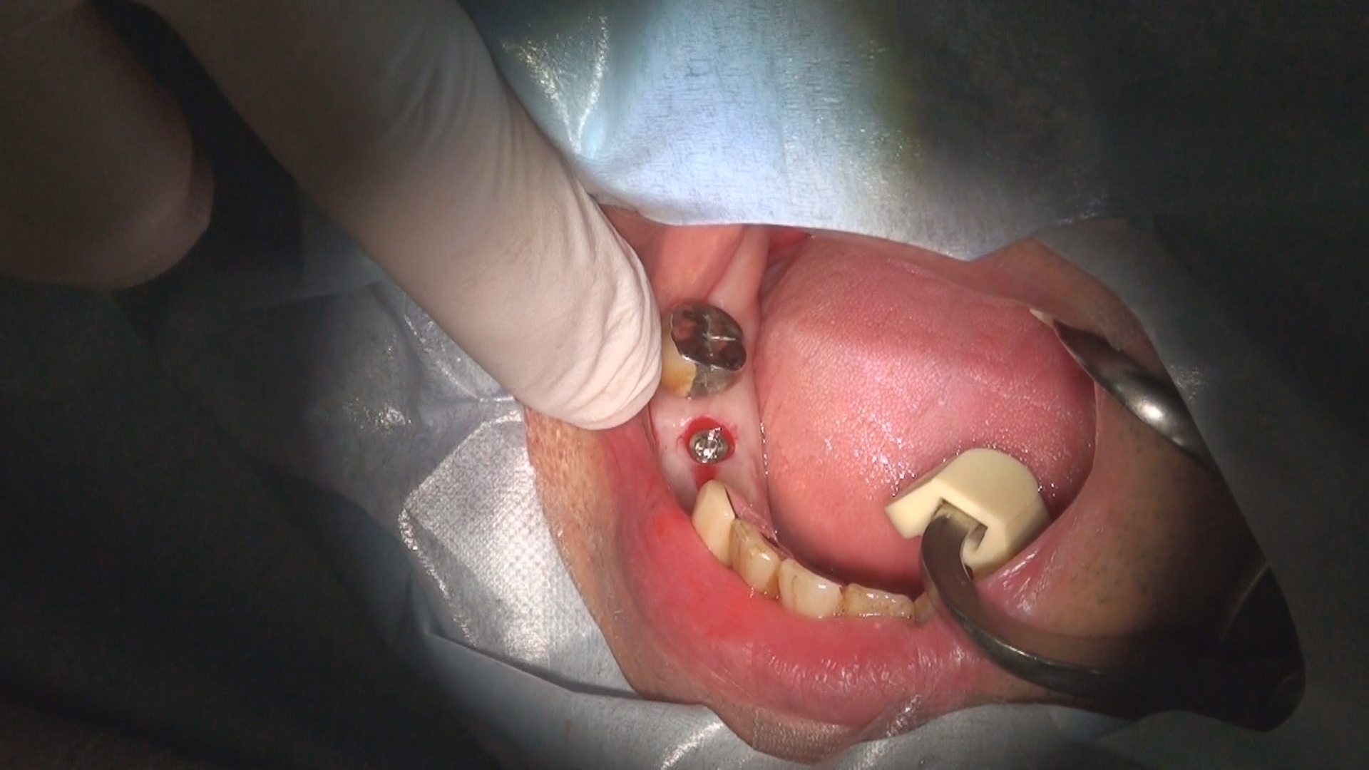 再生歯科治療