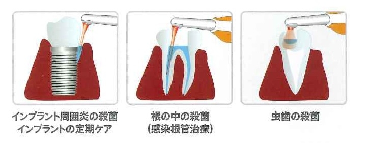 インプラントを行ううえで気を付けていること