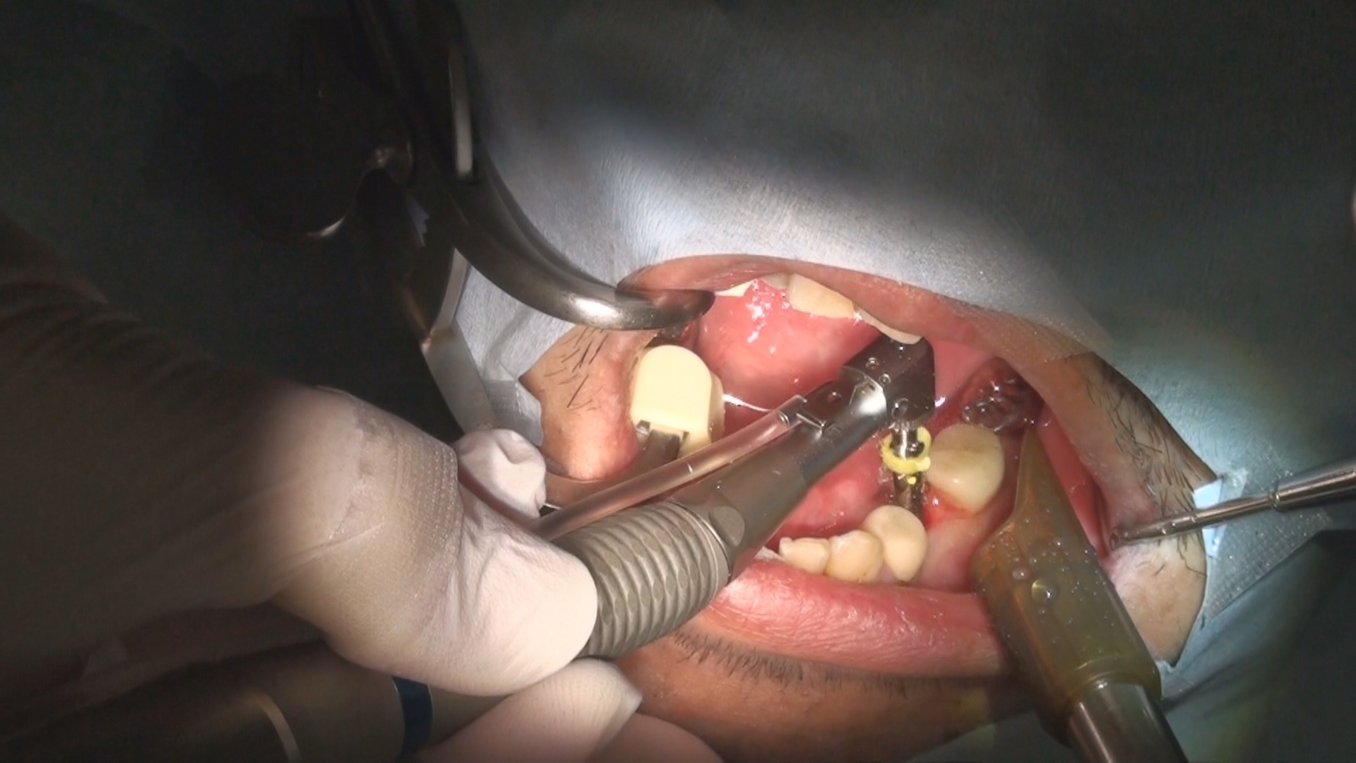 再生歯科治療