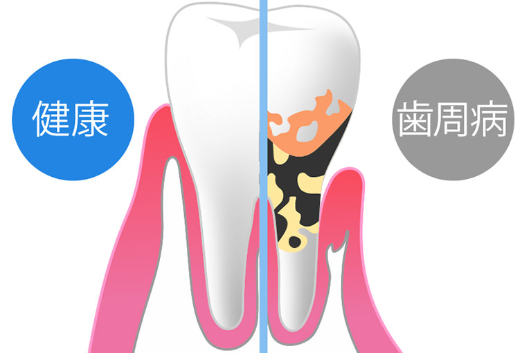 当院の歯周病ケア